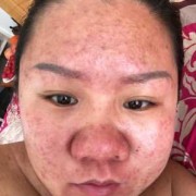 怀孕脸上长痘痘是什么原因,孕期脸上长痘痘是什么原因导致的