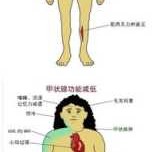 孕期甲减的症状,孕妇甲亢对胎儿的影响