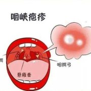 孕妇嗓子发炎肿痛怎么办,孕妇咽炎对胎儿的影响胎儿吗