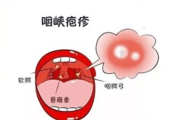 孕妇嗓子发炎肿痛怎么办,孕妇咽炎对胎儿的影响胎儿吗