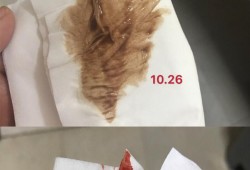 孕期吐出血（孕妇怀孕孕吐的时候吐出血怎么办好呢）