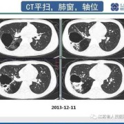 胎儿肺囊腺瘤（胎儿肺囊腺瘤是什么原因造成的）