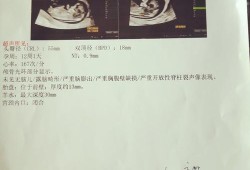 怀孕12周胎儿成型了吗（孕妇做nt检查多少钱，NT检查是检查什么的）