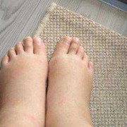 孕期浮肿怎么办（孕期浮肿怎么办?）