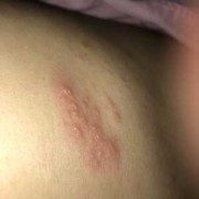 孕妇肚子上长湿疹怎么办,孕期肚子湿疹可以用金银花水擦吗