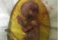 孕晚期弯腰胎儿死掉了（孕晚期弯腰胎儿死掉了）
