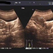 子宫双附件是什么,双子宫胎儿都比较小吗正常吗