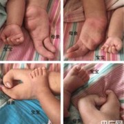 胎儿四肢短小该怎么办啊,胎儿手脚畸形是什么原因导致的