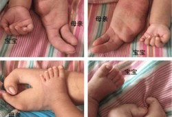 胎儿四肢短小该怎么办啊,胎儿手脚畸形是什么原因导致的