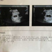 孕7周胚芽大小多少是正常的？怎么判断宝宝是否是健康的呢,7周胎儿发育情况图片