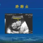 胎儿脐（胎儿脐膨出是什么原因导致的呢）