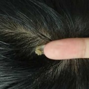 怀孕期间流黑色分泌物（怀孕期间流黑色分泌物是什么原因引起的）