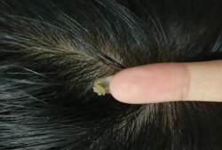 怀孕期间流黑色分泌物（怀孕期间流黑色分泌物是什么原因引起的）