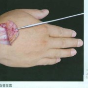 胎儿动脉细（手背静脉管突然变细是什么原因）