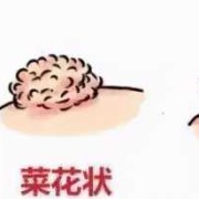 怀孕期间怎么会尖锐湿（怀孕期间怎么会尖锐湿长了一颗）