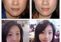孕期如何淡斑（孕期如何淡斑去黄）