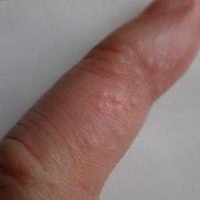 孕期手上长小水泡（孕晚期手上脚上长了许多小水泡咋回事啊）