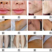 激光脱毛对胎儿有影响吗（激光脱毛对胎儿有影响吗）