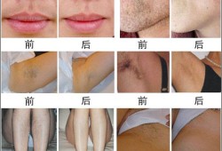 激光脱毛对胎儿有影响吗（激光脱毛对胎儿有影响吗）
