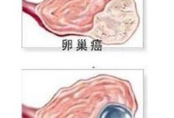 孕期卵巢囊肿怎么办啊,孕期发现卵巢囊肿怎么办啊?