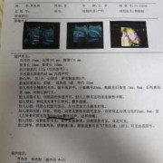四维检测说胎儿有肾囊肿怎么办,胎儿肾核磁共振