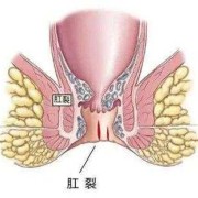 孕期肛裂（孕期肛裂）