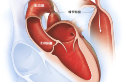 主动脉缩窄怎么办,胎儿主动脉弓狭窄,能不能要?