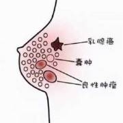 孕期乳房纤维瘤（孕期乳房纤维瘤变大怎么办）