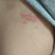 孕期长湿疹影响胎儿吗（孕妇在怀孕期间起湿疹对胎儿有影响吗）