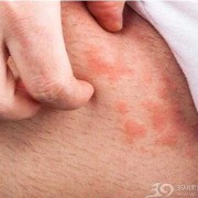 孕期阴毛处痒