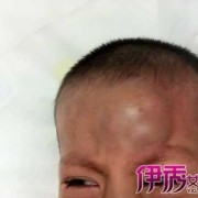 胎儿头皮水肿什么原因（宝宝头碰了个包怎么消肿）