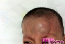 胎儿头皮水肿什么原因（宝宝头碰了个包怎么消肿）