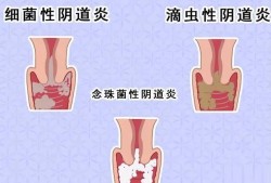 孕期滴虫性阴道炎（孕期有滴虫性阴炎怎么治疗）