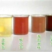 孕期血尿（孕期血尿）