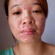 怀孕期间脸上长痘痘该怎么办,怀孕期间粉刺多怎么处理