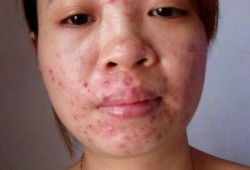 怀孕期间脸上长痘痘该怎么办,怀孕期间粉刺多怎么处理
