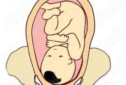 胎儿rop（胎儿rop）