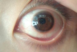 隐形眼镜在眼睛里找不到了怎么办,