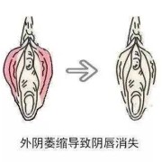 得了外阴白斑需要做手术吗,