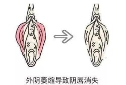 得了外阴白斑需要做手术吗,