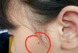 孕期痣变大的原因（右脸颊靠近耳边有痣变大了是不是有疾病）