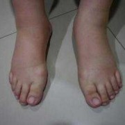 孕期腿浮肿（孕期腿浮肿是什么原因）