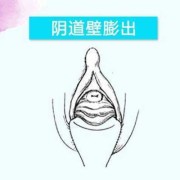 孕期阴道会松弛吗（阴壁膨出1度2度3度图）