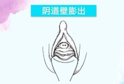 孕期阴道会松弛吗（阴壁膨出1度2度3度图）