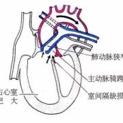 胎儿法洛四联症（胎儿法洛四联症能要吗）