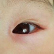 7个月宝宝眼睛周围总起红疙瘩是怎么了,七个多月胎儿图片