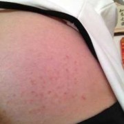 怀孕外阴瘙痒影响胎儿