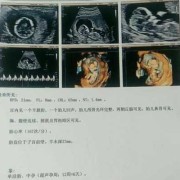 胎儿检查nt（nt检查是什么?孕期做nt检查是检查什么项目呢）