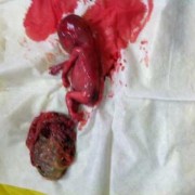 胎儿腹腔囊性包块（子宫囊性包块怎么办）