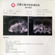 胎儿系统超声检查时间（彩超多长时间可以做一次）